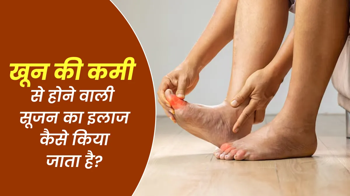 खून की कमी (एनीमिया) से होने वाली सूजन का इलाज कैसे किया जाता है? जानें डॉक्टर से