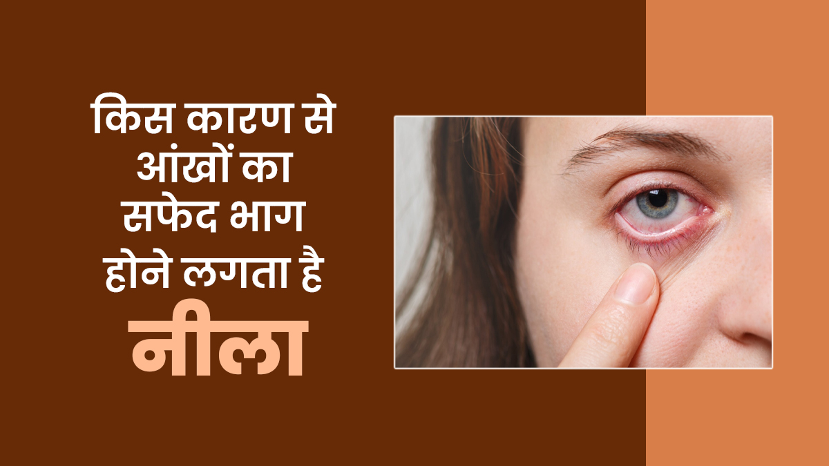 किस कारण से आंखों का सफेद भाग होने लगता है नीला, जानें डॉक्टर से