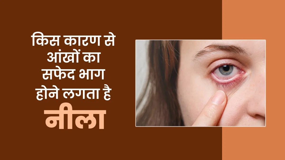 किस कारण से आंखों का सफेद भाग होने लगता है नीला, जानें डॉक्टर से