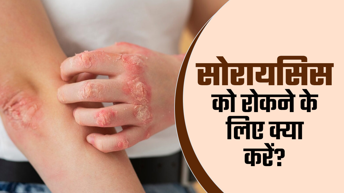सोरायसिस को रोकने के लिए करें ये काम, स्किन रहेगी हेल्दी