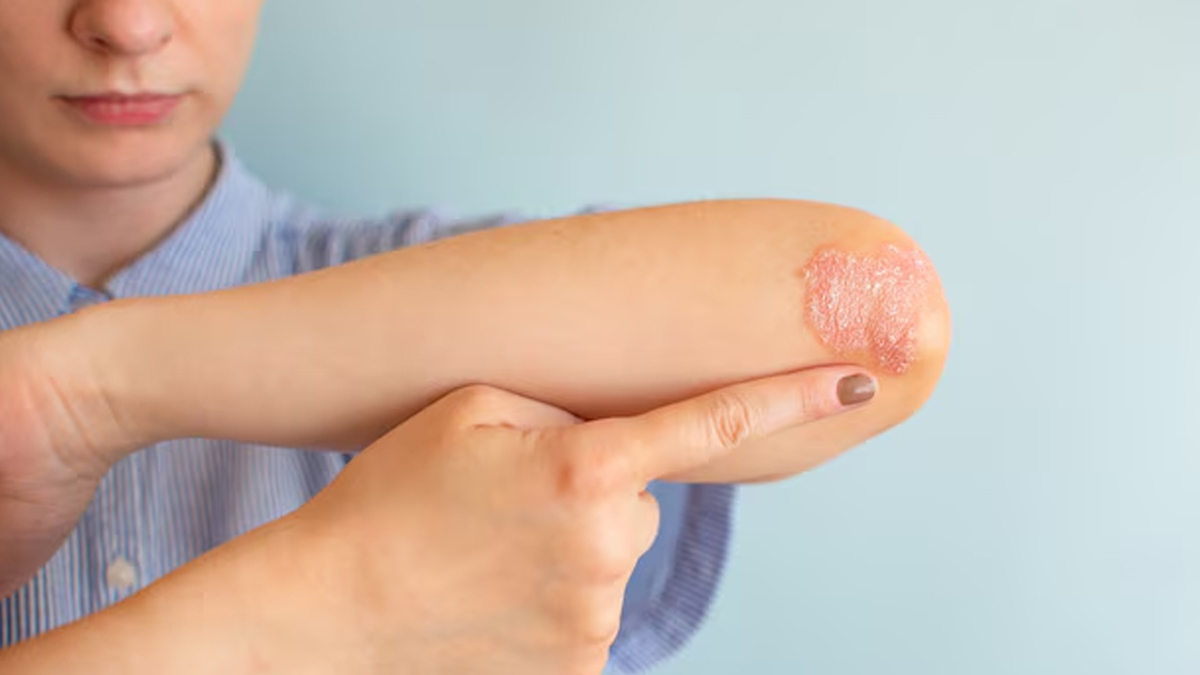 how do you stop psoriasis from forming in hindi 1