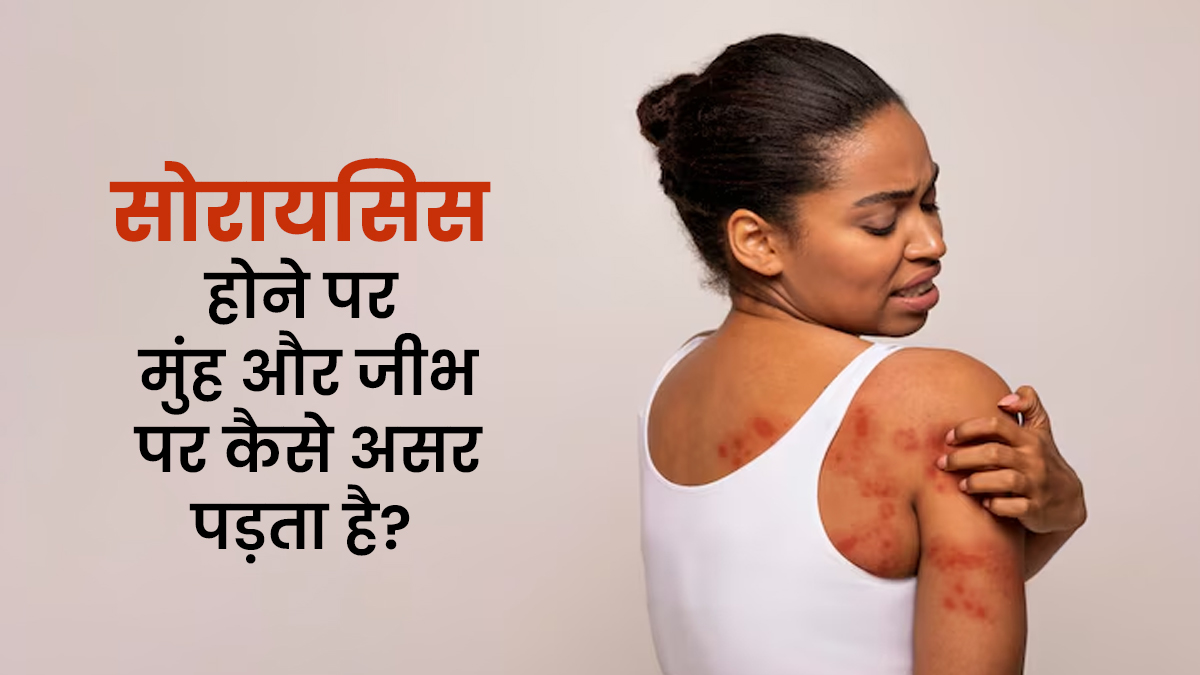 सोरायसिस होने पर मुंह और जीभ पर कैसे असर पड़ता है? जानें डॉक्टर से