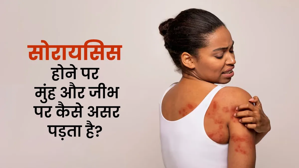 सोरायसिस होने पर मुंह और जीभ पर कैसे असर पड़ता है? जानें डॉक्टर से