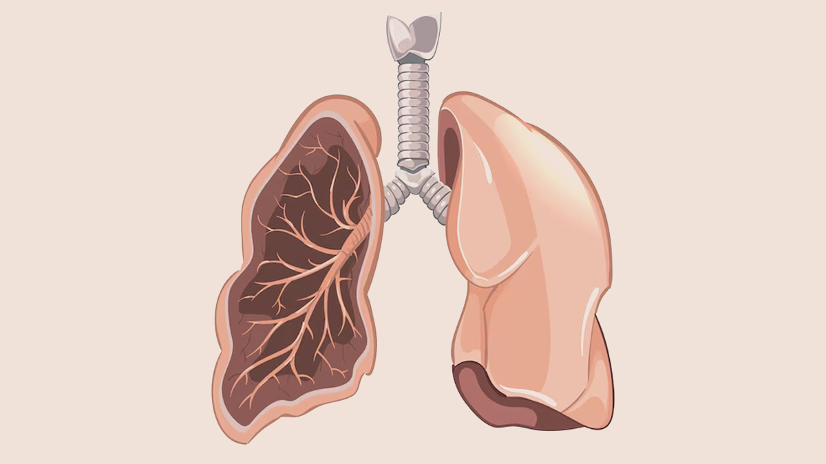 वर्ल्ड लंग्स कैंसर डे का इतिहास, महत्व और थीम | world Lung Cancer 2025 Day theme history and importance in hindi 3_lung cancer