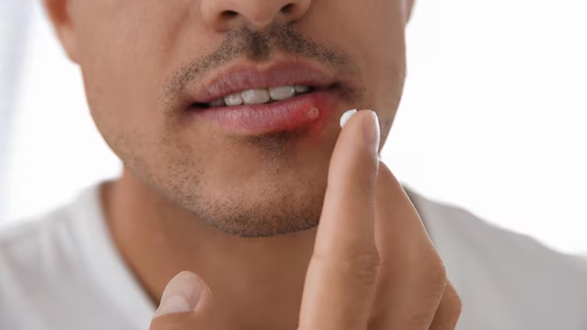 How can psoriasis affect the mouth and tongue-inside