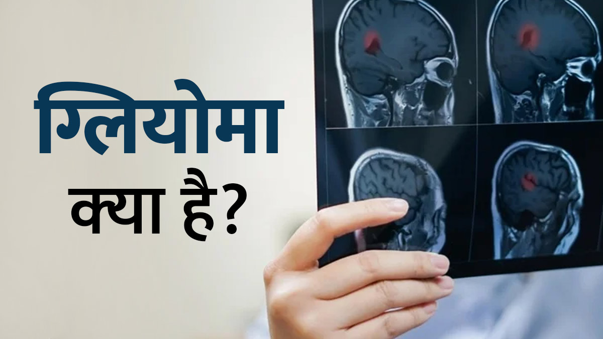 ग्लियोमा (ब्रेन ट्यूमर) क्‍या है? डॉक्‍टर से जानें इसके लक्षण, कारण और इलाज