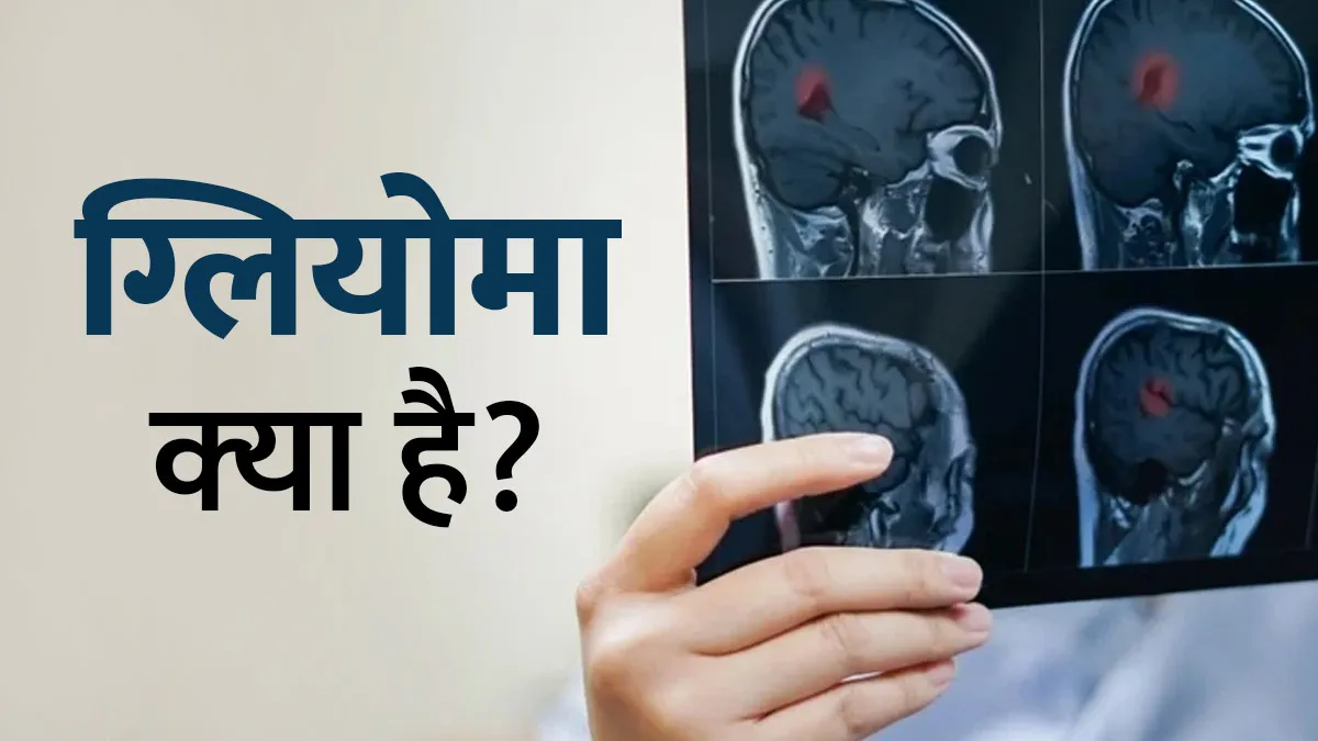 ग्लियोमा (ब्रेन ट्यूमर) क्‍या है? डॉक्‍टर से जानें इसके लक्षण, कारण और इलाज