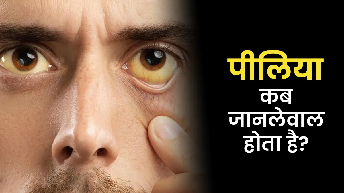 पीलिया कब जानलेवा होता है? डॉक्टर से जानें लें, ताकि समय रहते बच जाएगी जान