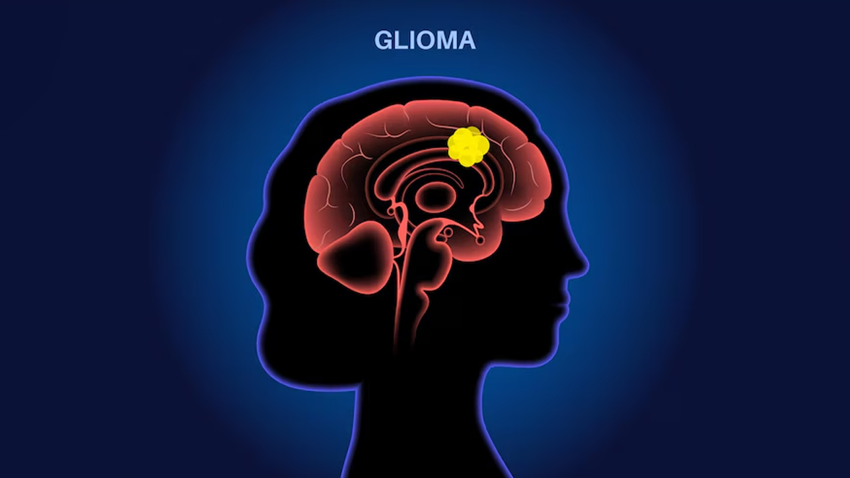 glioma-symptoms-in-hindi