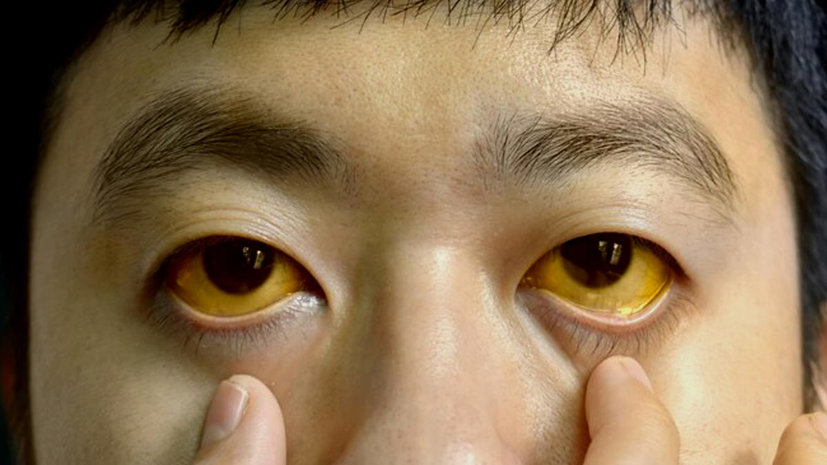 when does jaundice become fatal in hindi 01 (5)