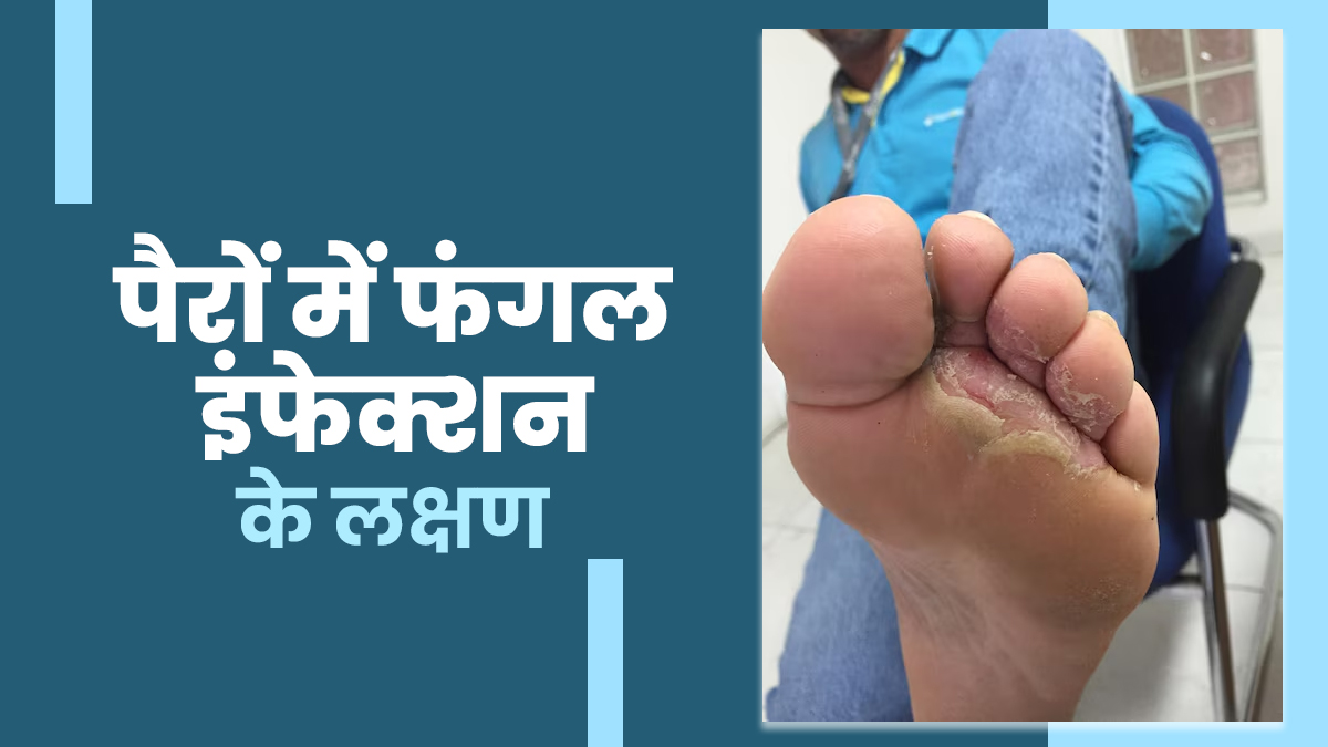 बारिश में पैरों की उंगलियों में रहती है खुजली और जलन! फूट फंगल इंफेक्शन का हो सकते हैं लक्षण, न करें नजरअंदाज