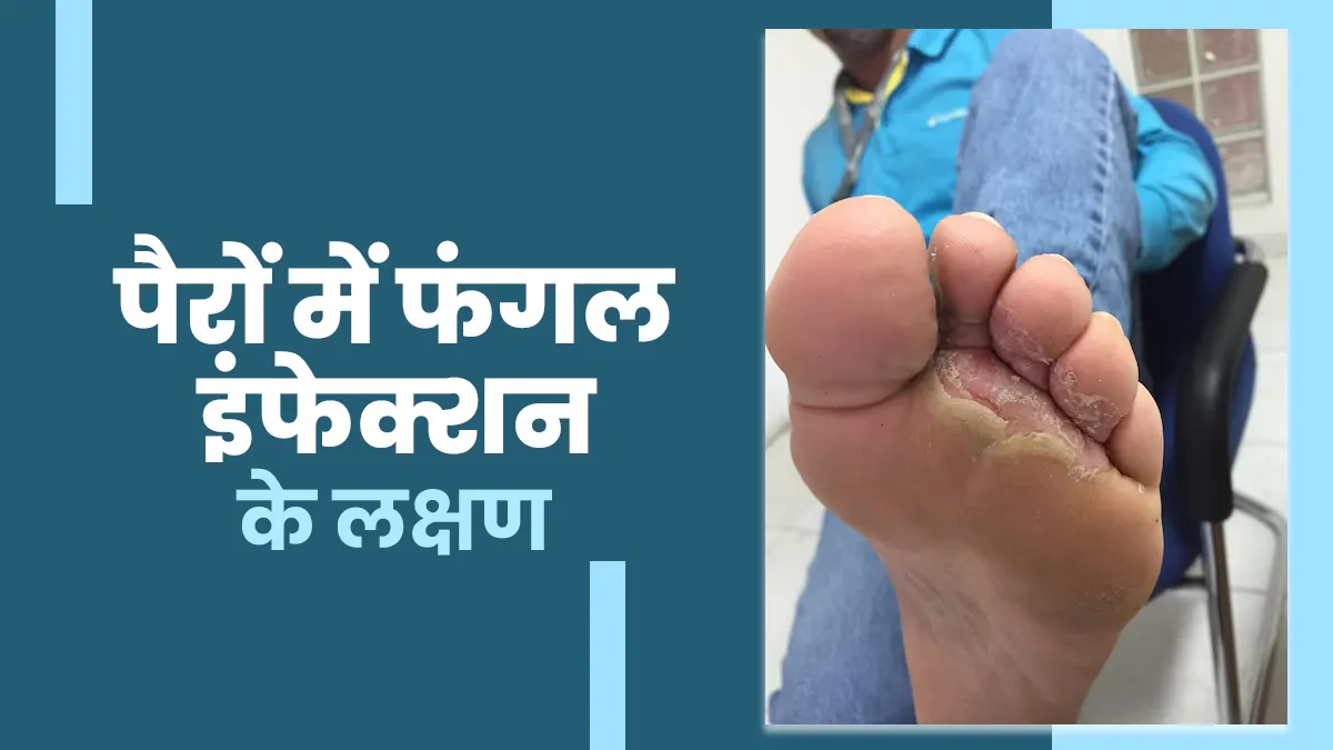 बारिश में पैरों की उंगलियों में रहती है खुजली और जलन! फूट फंगल इंफेक्शन का हो सकते हैं लक्षण, न करें नजरअंदाज