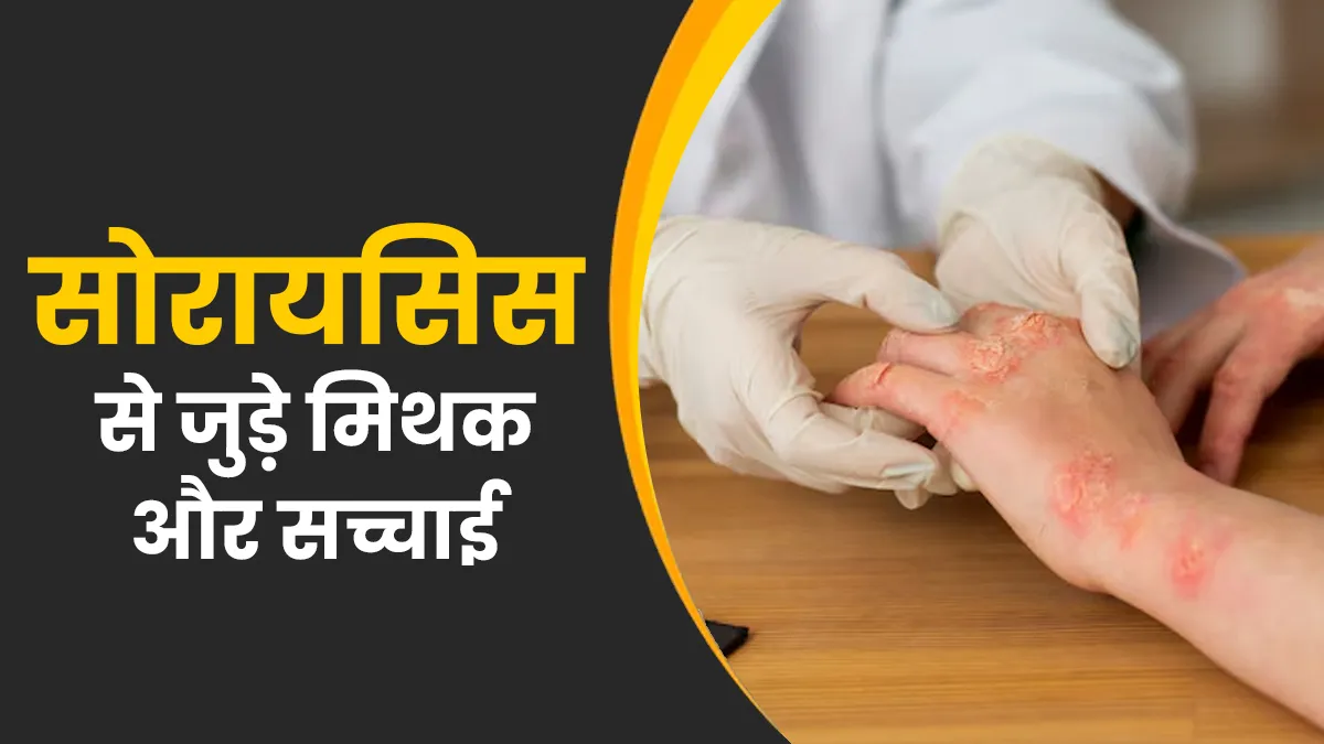 क्या सोरायसिस फैलने वाली बीमारी है? जानें ऐसे 7 मिथकों के जवाब डॉक्टर से