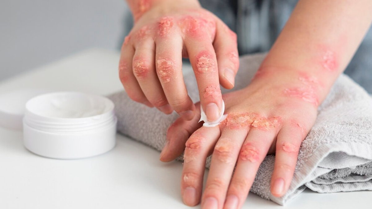 myths and facts about psoriasis experts