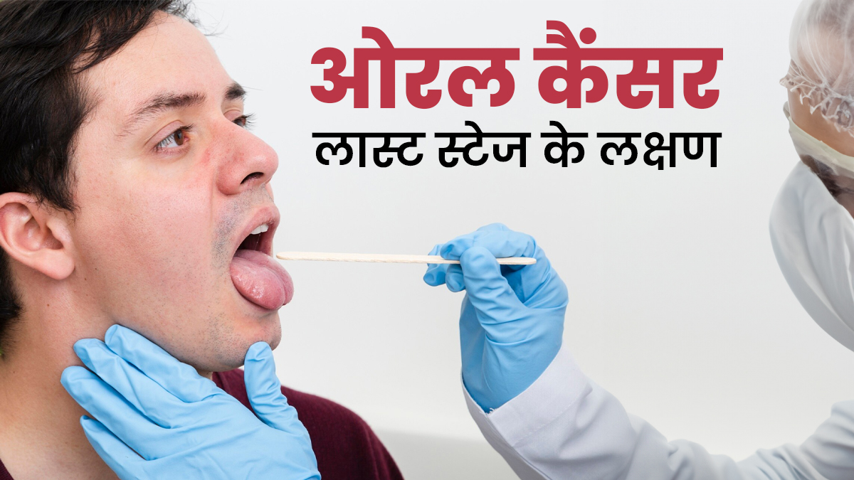 ओरल कैंसर के होते हैं 4 स्टेज, जानें क्या होते हैं लास्ट स्टेज के लक्षण