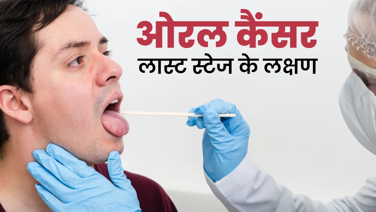 ओरल कैंसर के होते हैं 4 स्टेज, जानें क्या होते हैं लास्ट स्टेज के लक्षण