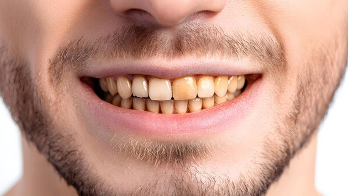 how to remove yellowish layer from teeth with alum or fitkari in hindi 1