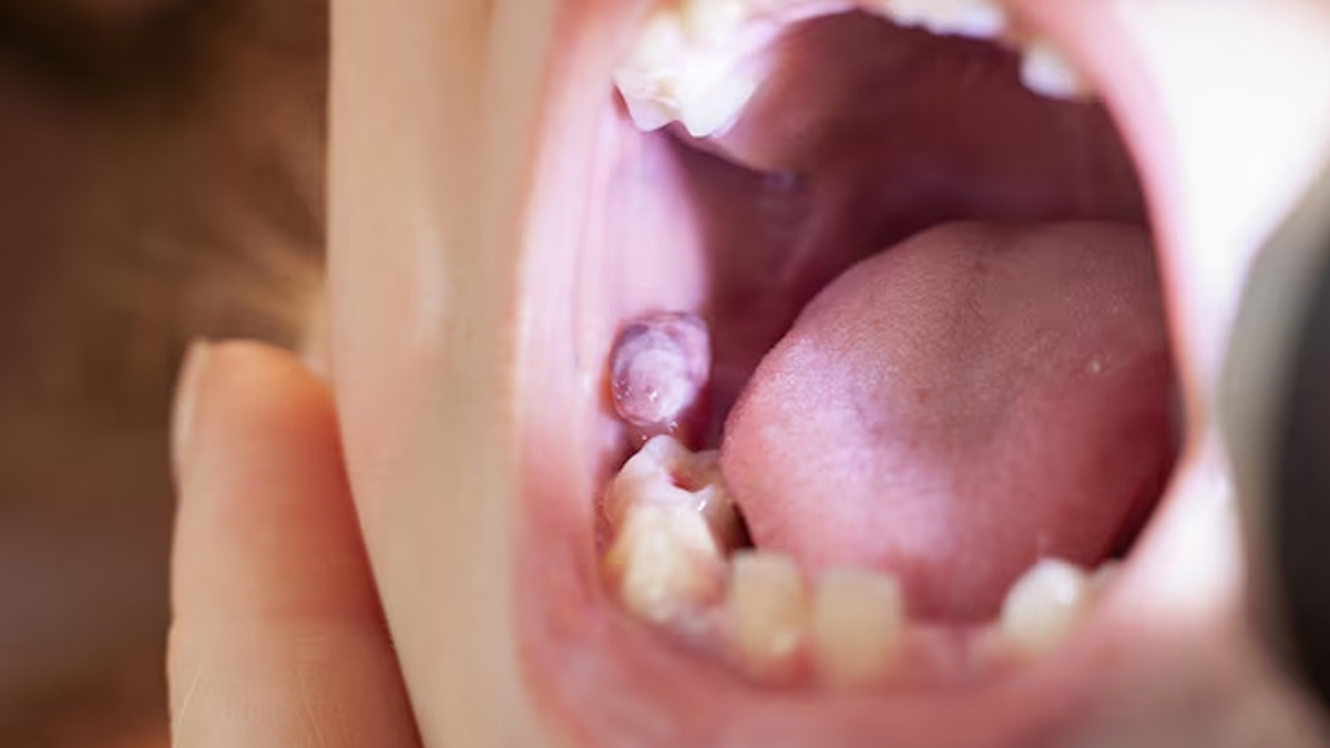 oral-cancer-symptoms-inside