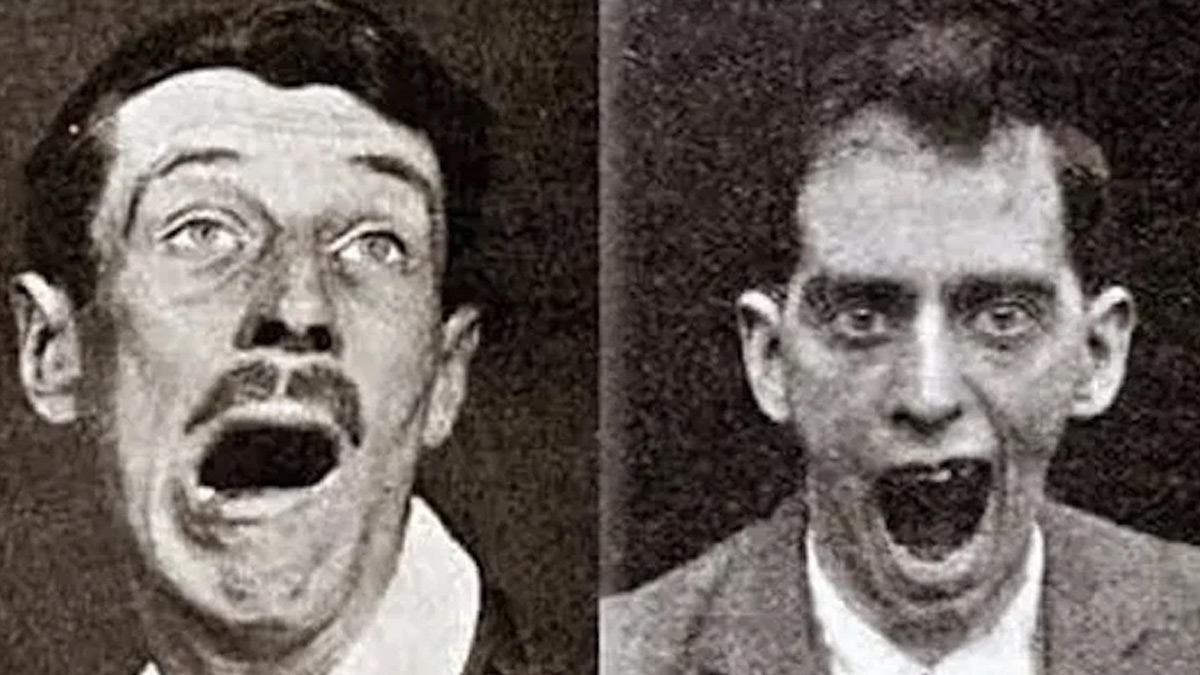 encephalitis-lethargica-treatment