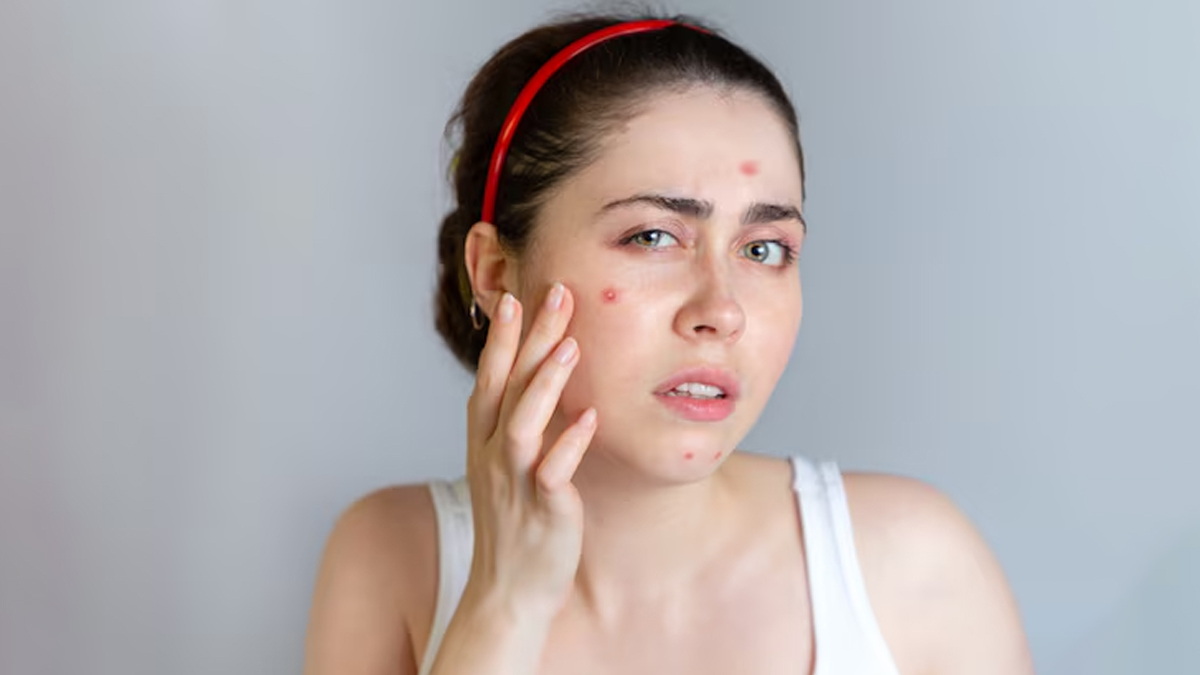 skin-problems-caused-by-oily-foods