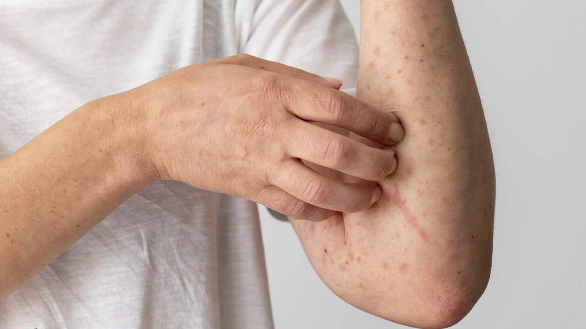 what causes skin allergies and rashes in hindi 01 (5)