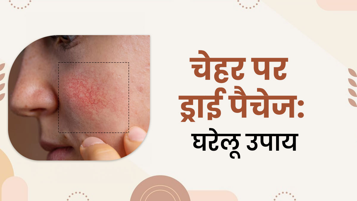 चेहरे के ड्राई पैचेज दूर करने के ल‍िए अपनाएं ये 5 घरेलू उपाय, म‍िलेगी कोमल त्‍वचा