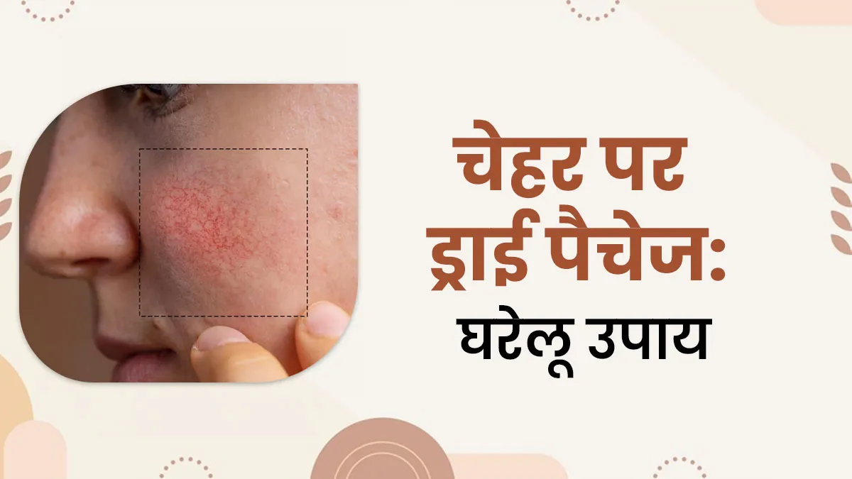 चेहरे के ड्राई पैचेज दूर करने के ल‍िए अपनाएं ये 5 घरेलू उपाय, म‍िलेगी कोमल त्‍वचा