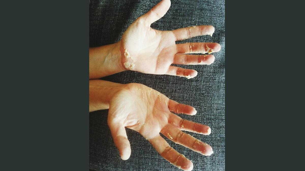 Hypohidrotic-ectodermal-dysplasia-inside