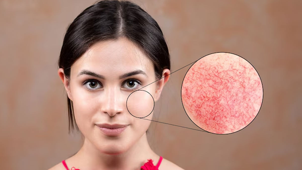 dry-patches-on-skin-home-remedies