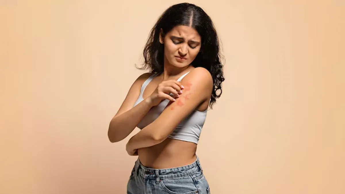 क्या आपको भी होती है पित्ती में खुजली? जानें ऐसा क्यों नहीं करना चाहिए
