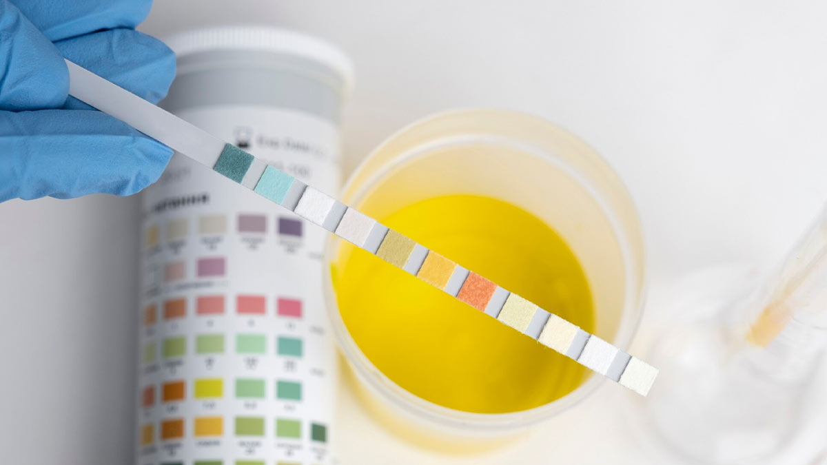 do gallstones change urine color 01 (7)