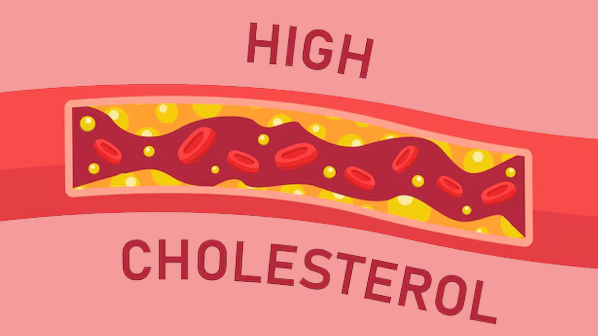 high cholesterol