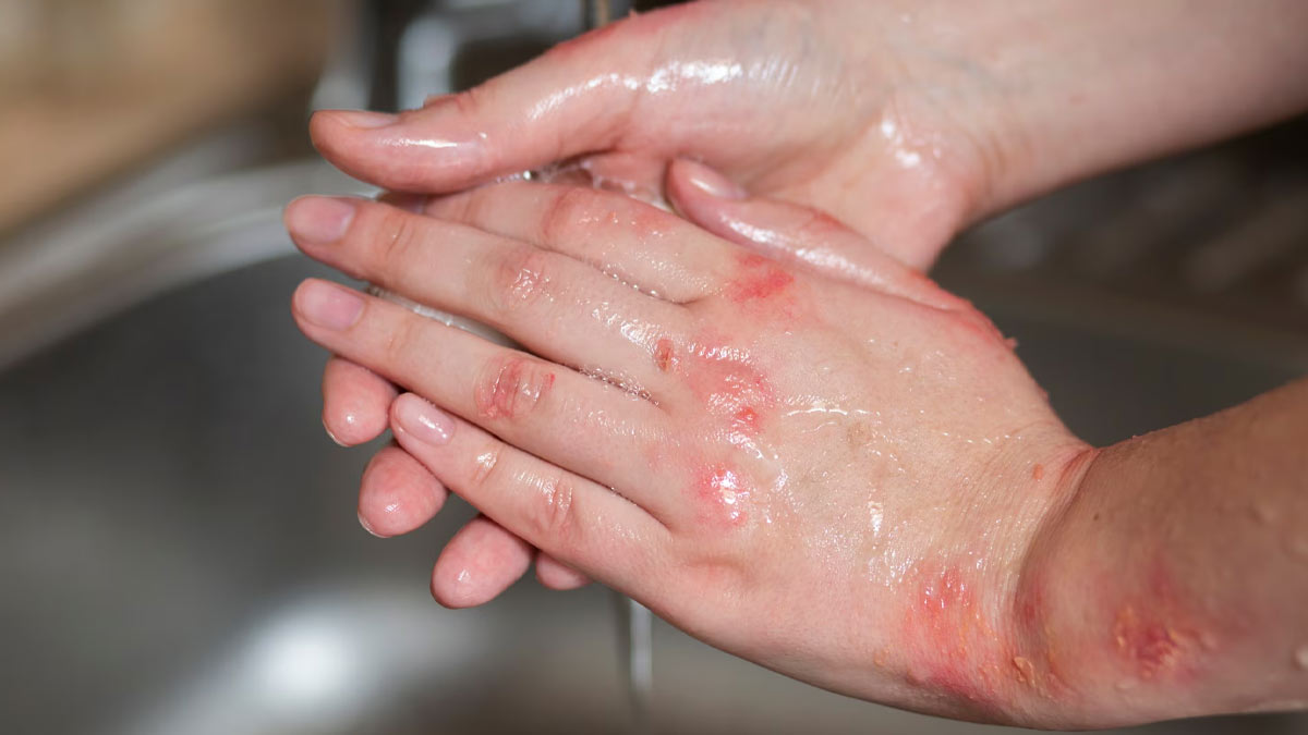 herb for fungal infection