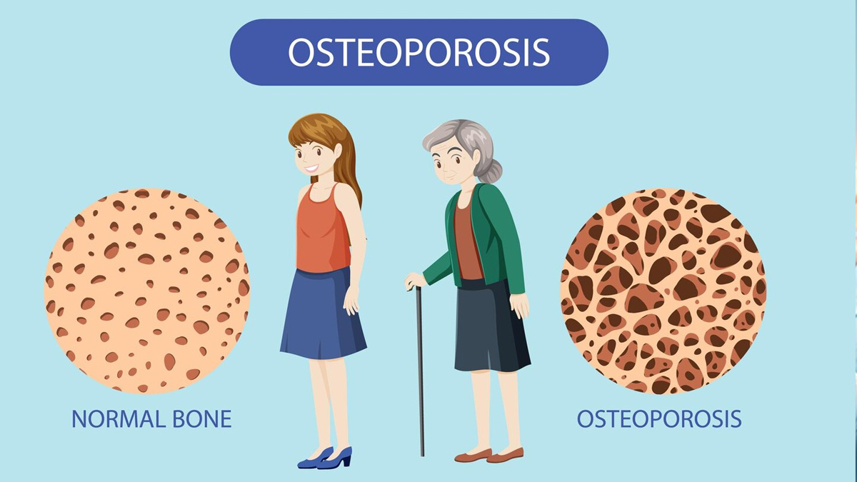 Osteoporosis-se-bachne-ke-upay