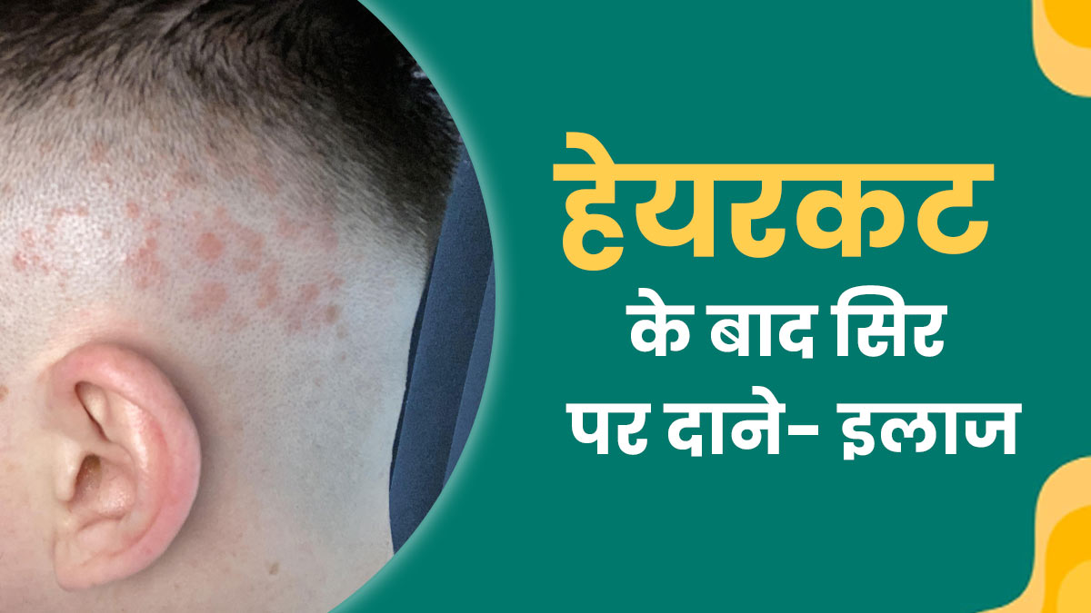 बाल कटवाने के बाद सिर पर होते हैं दाने? डॉक्‍टर से जानें इलाज