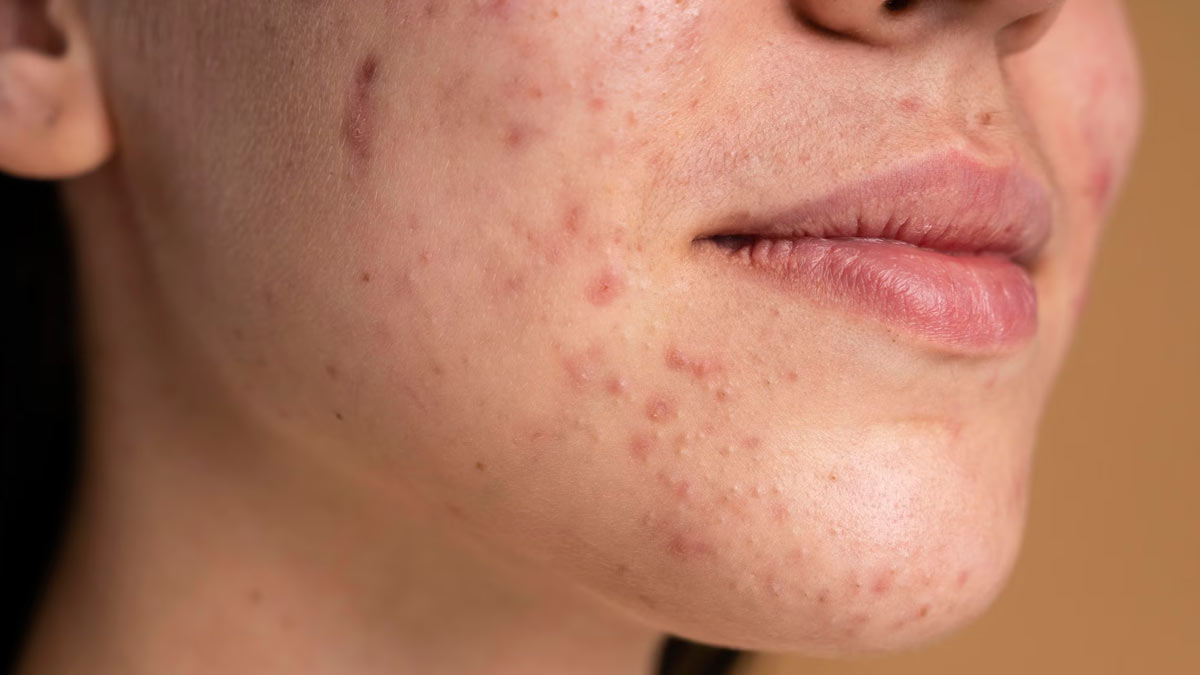 why does acne happen on the chin in hindi 01 (5)