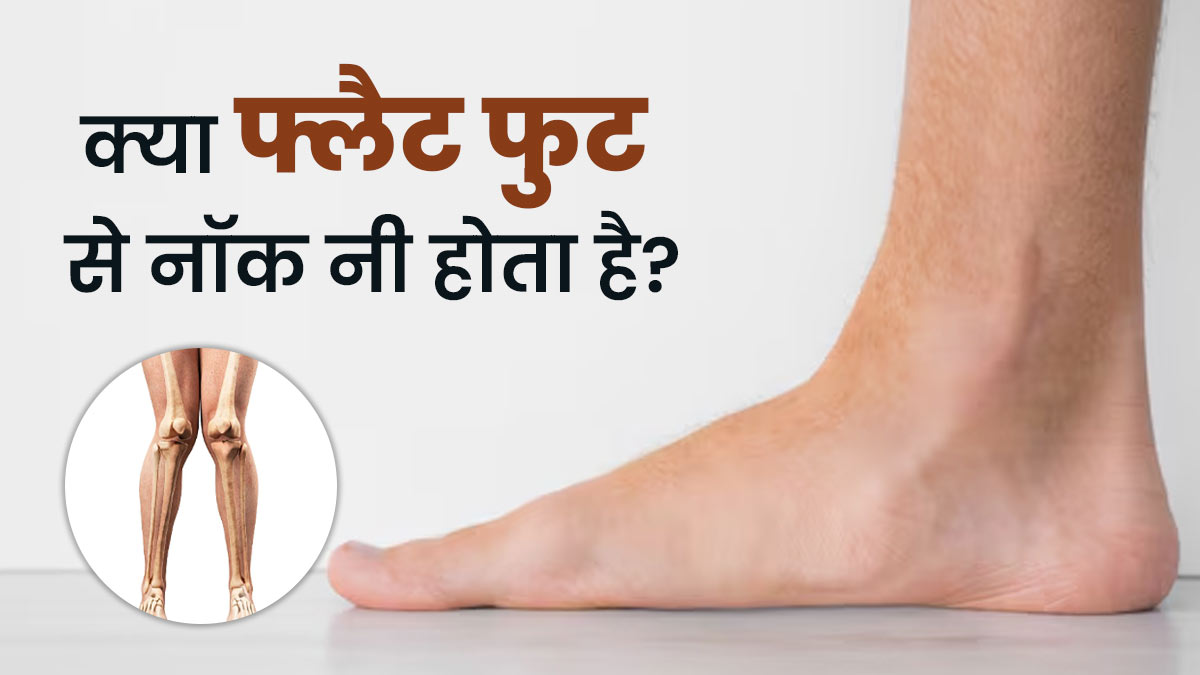 क्या फ्लैट फुट के कारण नॉक नी की समस्या हो सकती है? डॉक्टर से जानें