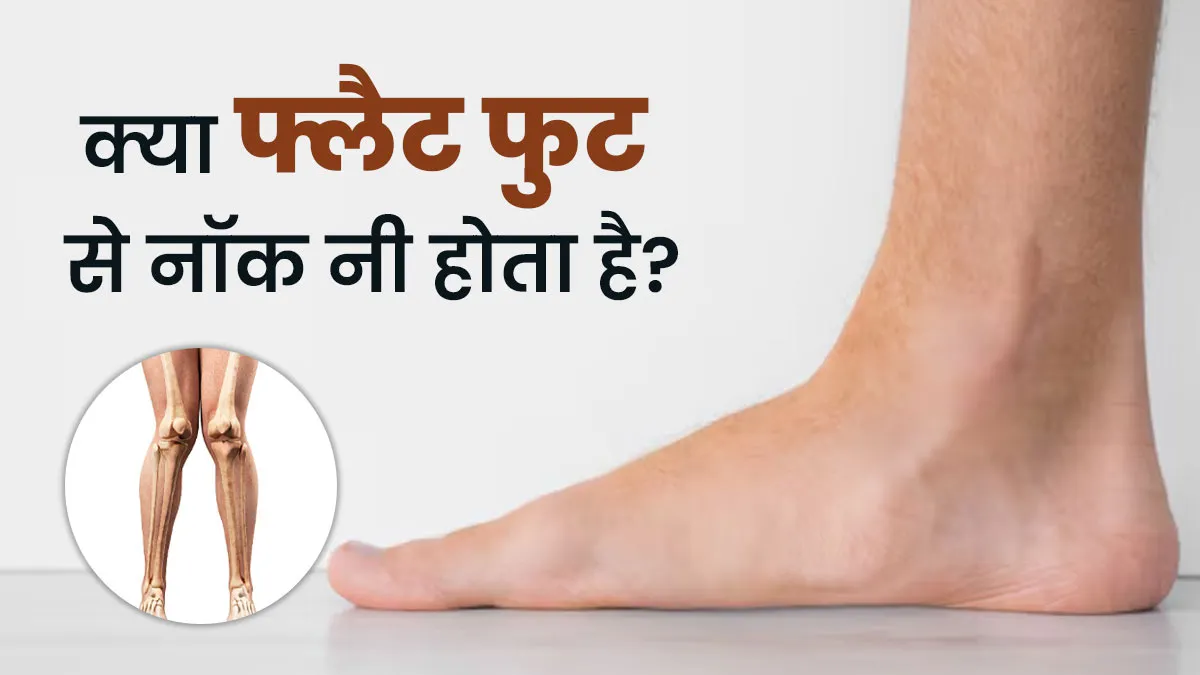 क्या फ्लैट फुट के कारण नॉक नी की समस्या हो सकती है? डॉक्टर से जानें