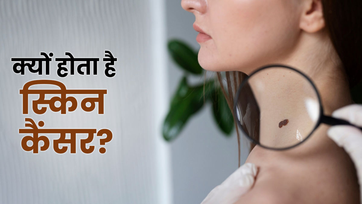 क्यों होता है स्किन कैंसर? जानें इसके कारण