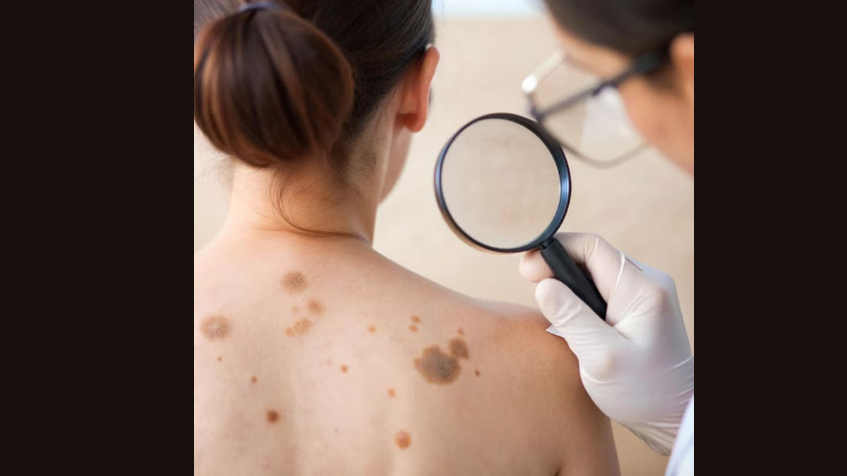 why does skin cancer occur know its causes in hindi 01 (5)