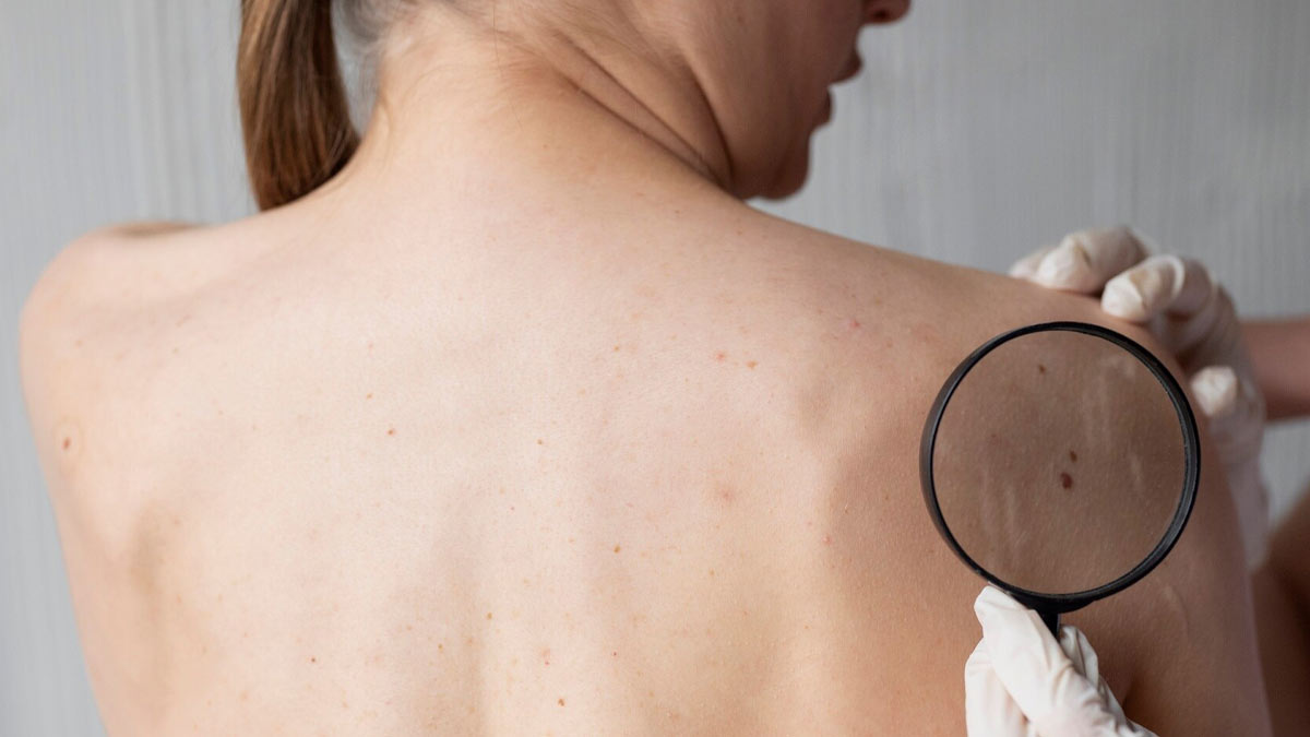 types of skin cancer and their preventive measures in hindi 1