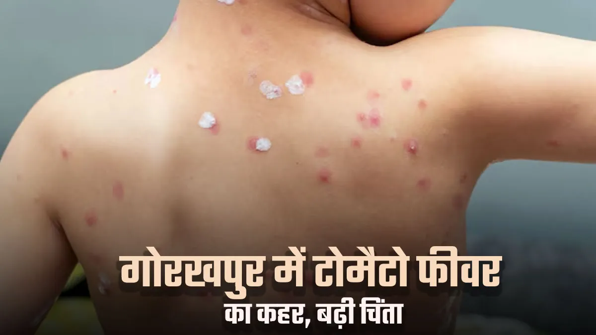 गोरखपुर में फैले टोमैटो फीवर से 12 मासूम हुए बीमार, जानें ऐसी स्‍थ‍िति‍ में बच्‍चों को कैसे रखें सुरक्ष‍ित