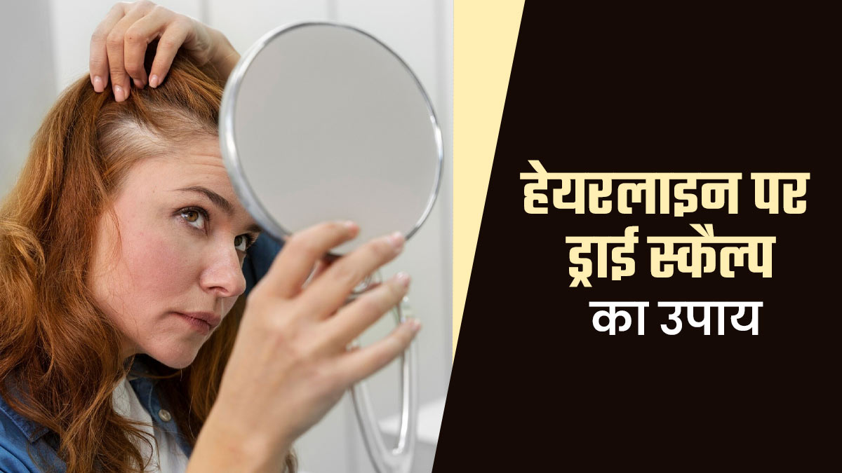 हेयरलाइन पर ड्राई स्कैल्प क्यों है? एक्सपर्ट से जानें इसे ठीक करने के उपाय