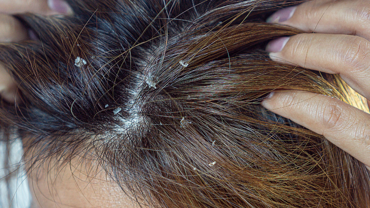 Monsoon-Dandruff-Seborrheic-Dermatitis