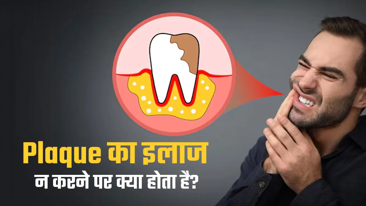 प्लाक का इलाज न करने पर बढ़ सकती हैं ये 3 परेशानियां, सही नहीं है अनदेखी
