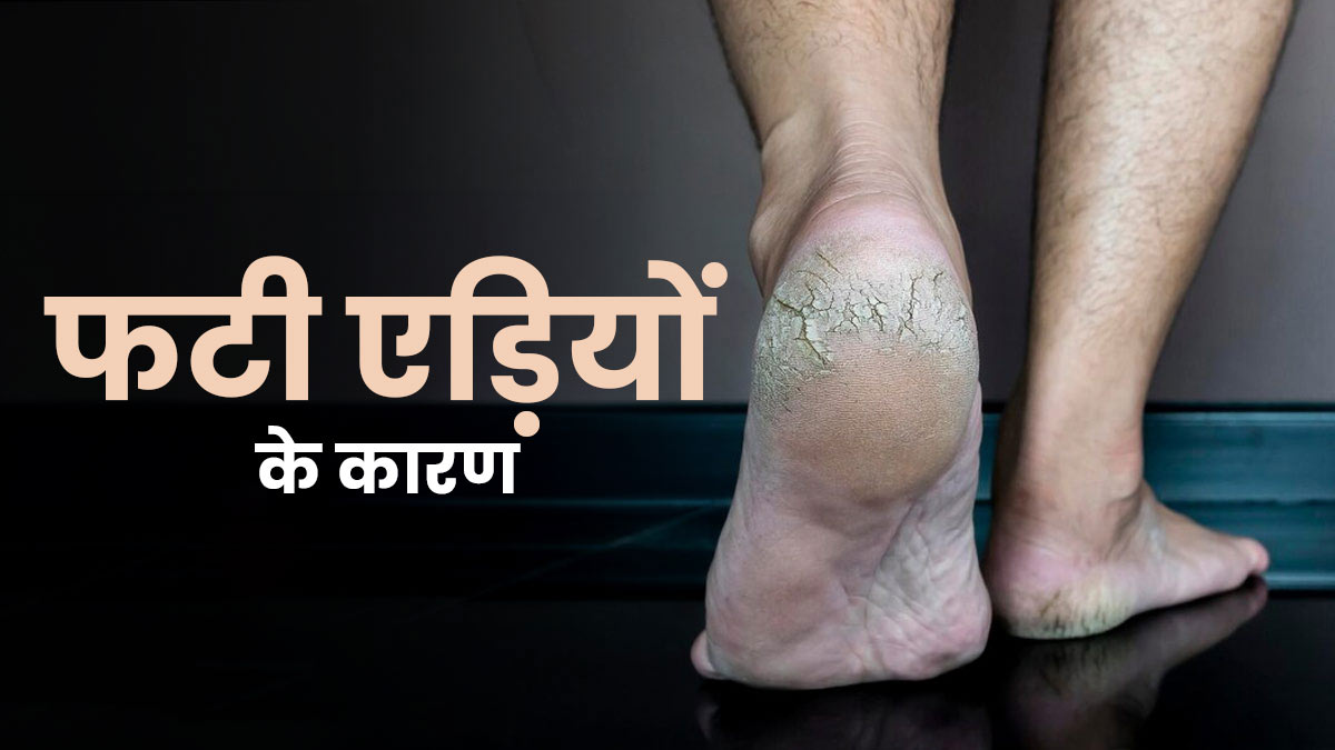 आपकी भी एड़ियां फटी रहती हैं? जानें इसके कारण