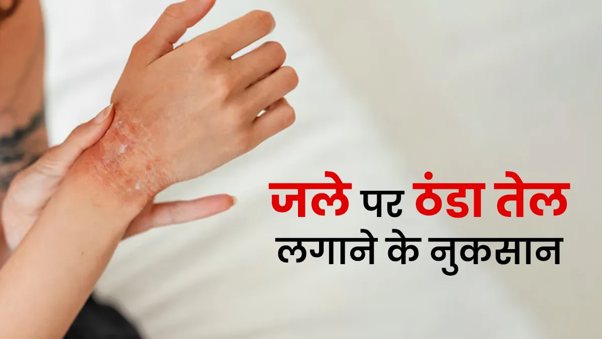 जले हुए पर ठंडा तेल लगाने से नहीं मिलता आराम, एक्सपर्ट ने बताया बढ़ सकती है दिक्कत