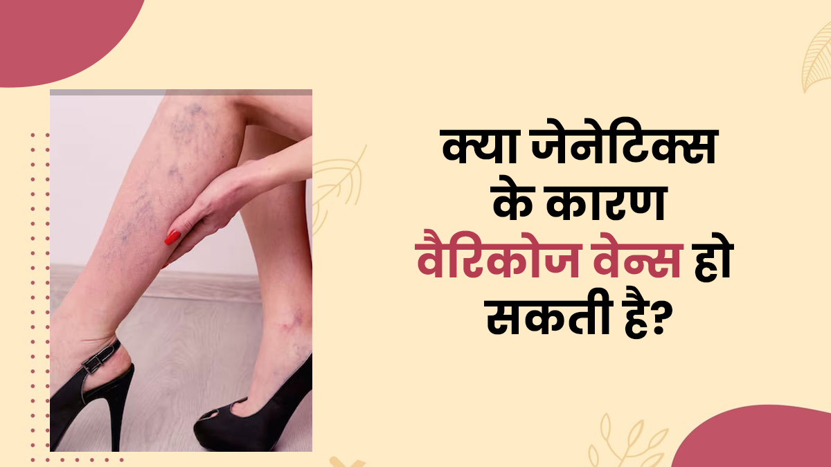 क्या जेनेटिक कारणों से भी वैरिकोज वेन्स की समस्या हो सकती है? डॉक्टर से जानें
