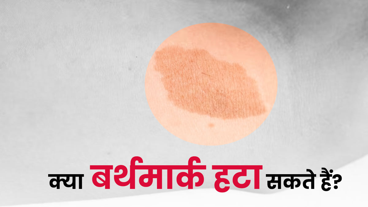 क्या हम बर्थमार्क हटा सकते हैं? डॉक्टर से जानें