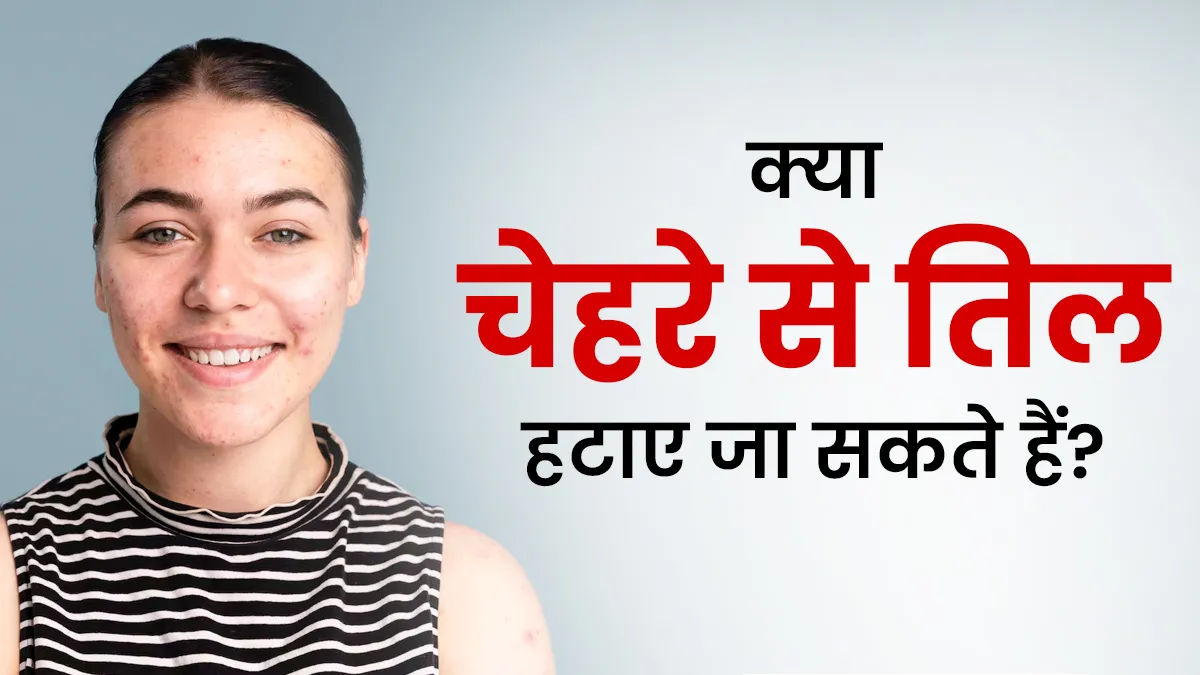 क्या चेहरे से तिल हटाए जा सकते हैं? डॉक्टर से जानें सच्चाई